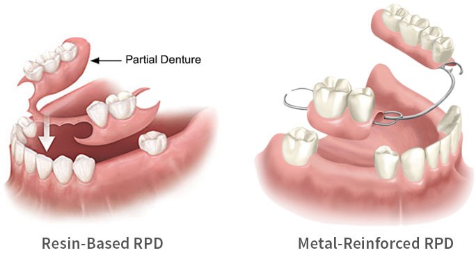 Occlusion In Complete Dentures Cologne NJ 8213